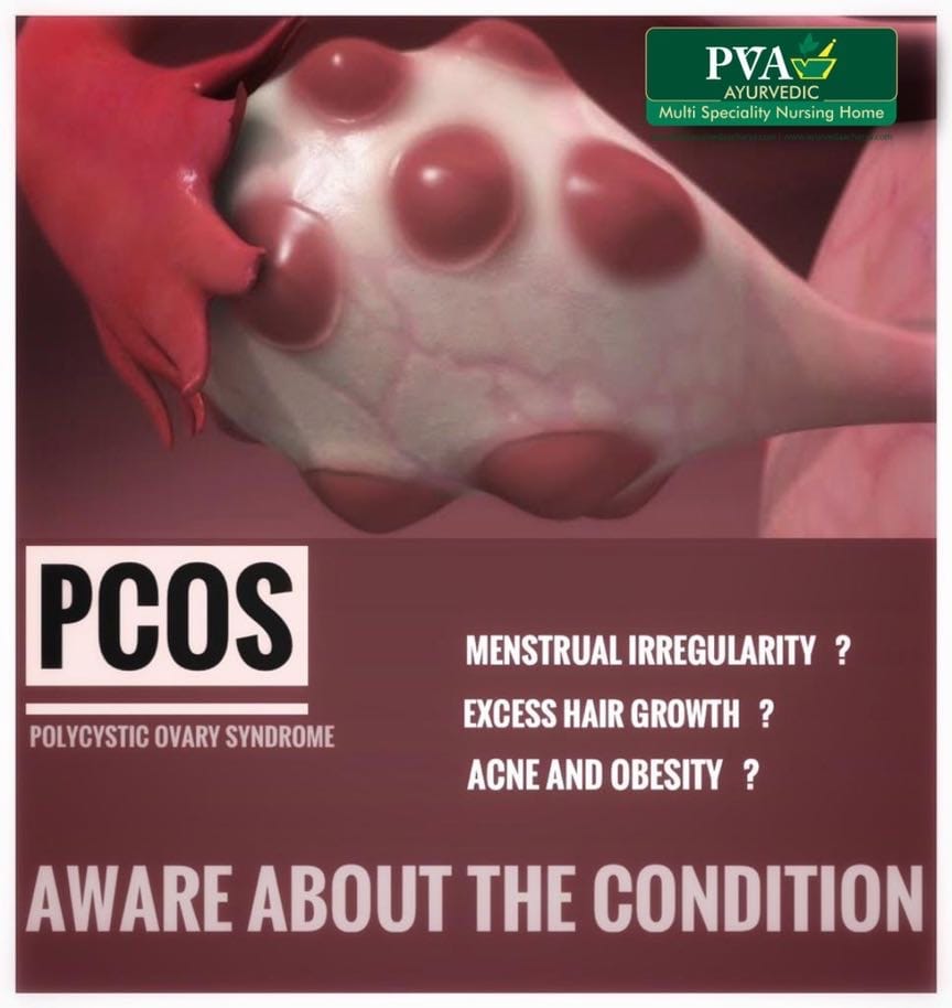 POLYCYSTIC OVARY SYNDROME (PCOS)