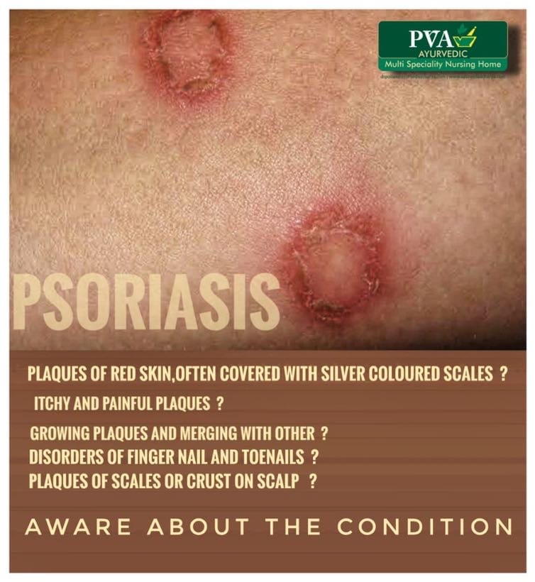 PSORIASIS